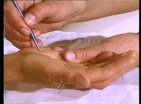 Su Jok-Akupunktur-DVD-Version